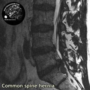 simple_hernia_l-spine_MRI_1