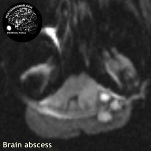 abscess_head MRI_2