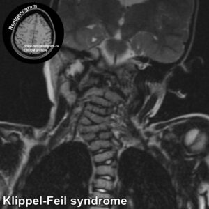 Klippel-Feil syndrome_MRI_2