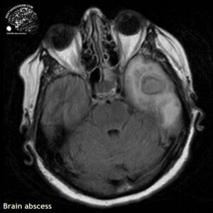 abscess_head MRI_3