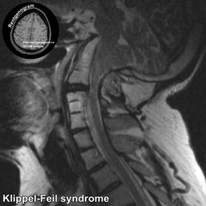 Klippel-Feil syndrome_MRI_3