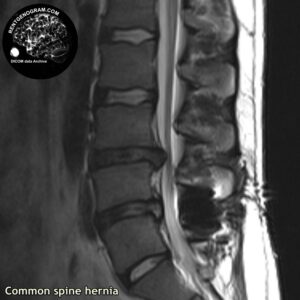 simple_hernia_l-spine_MRI_3