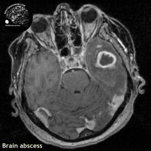 abscess_head MRI_4