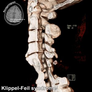 Klippel-Feil syndrome_CT_4