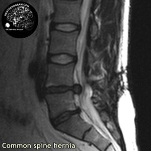 simple_hernia_l-spine_MRI_4