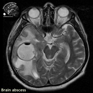 abscess_head MRI_5