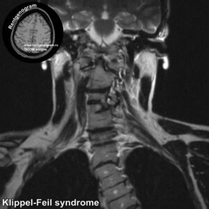 Klippel-Feil syndrome_MRI_5