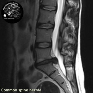simple_hernia_l-spine_MRI_5