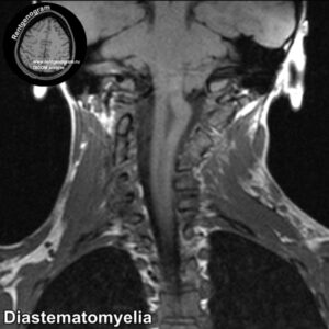 Diastematomyelia_MRI_1