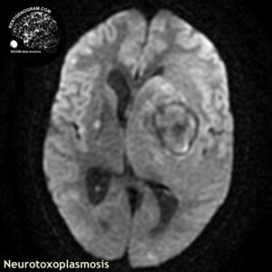 toxoplasmosis_head MRI_1