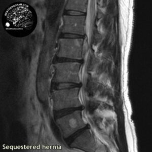sequestr_hernia_l-spine_MRI_2