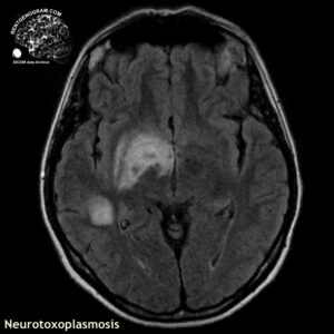 toxoplasmosis_head MRI_2