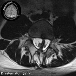 Diastematomyelia_MRI_3