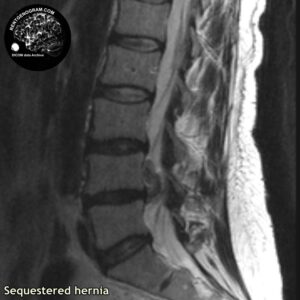sequestr_hernia_l-spine_MRI_3