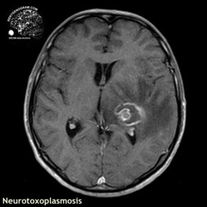 toxoplasmosis_head MRI_3