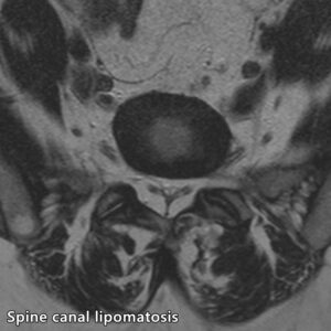 lipomatosis_epiduralis_mri_t2_tra