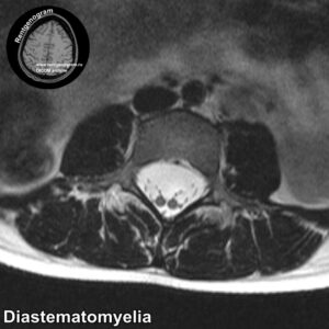 Diastematomyelia_MRI_4