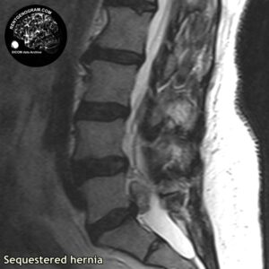 sequestr_hernia_l-spine_MRI_4