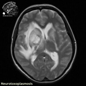 toxoplasmosis_head MRI_4