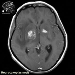 toxoplasmosis_head MRI_5