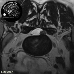 extrusia_hernia_l-spine_MRI_1