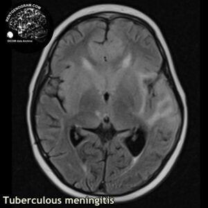 tbc_head MRI_1