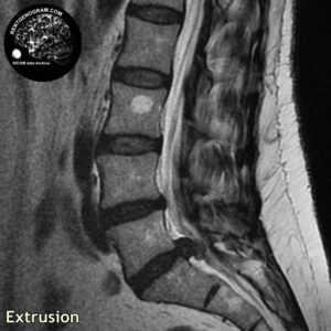 extrusia_hernia_l-spine_MRI_2