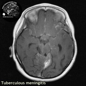 tbc_head MRI_2