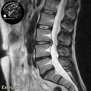 extrusia_hernia_l-spine_MRI_4