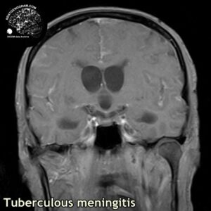 tbc_head MRI_4