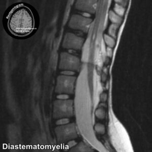 5.5-Diastematomyelia_MRI_5-ts1620477465