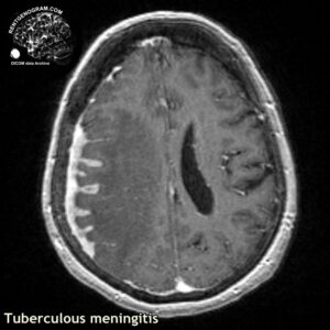 tbc_head MRI_5