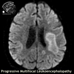 PML_head MRI_1