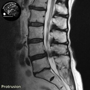 protrusio_hernia_l-spine_MRI_1