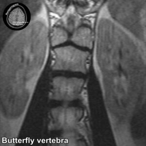 Butterfly vertebra MRI_1