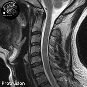 protrusio_hernia_l-spine_MRI_2