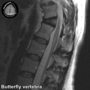 Butterfly vertebra MRI_2