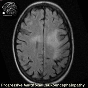 PML_head MRI_3