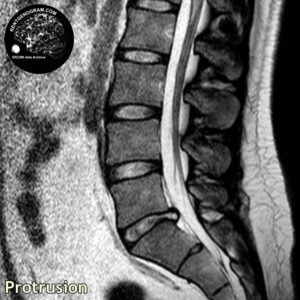 protrusio_hernia_l-spine_MRI_3