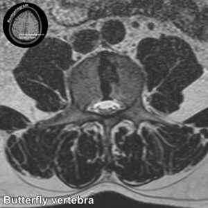 Butterfly vertebra MRI_3