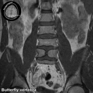 Butterfly vertebra MRI_4