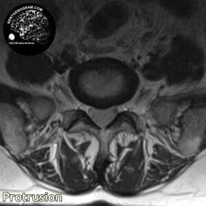 protrusio_hernia_l-spine_MRI_5