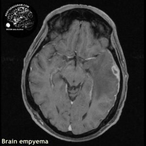 empyema_head MRI_1