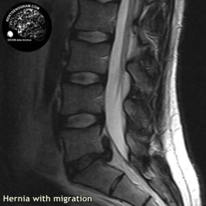migratio_hernia_l-spine_MRI_1