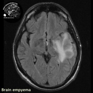empyema_head MRI_2