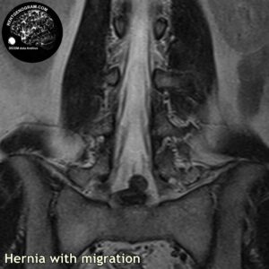 migratio_hernia_l-spine_MRI_2