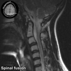 Spinal fusion_MRI_1