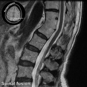 Spinal fusion_MRI_3