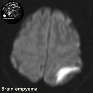 empyema_head MRI_4