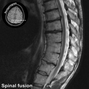 Spinal fusion_MRI_4